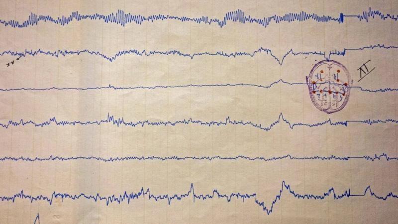 ورقة طبية عليها تسجيلات لموجات كهربائية مرسومة بخطوط متعرّجة ومتوازية، تشبه تخطيط كهربائية الدماغ