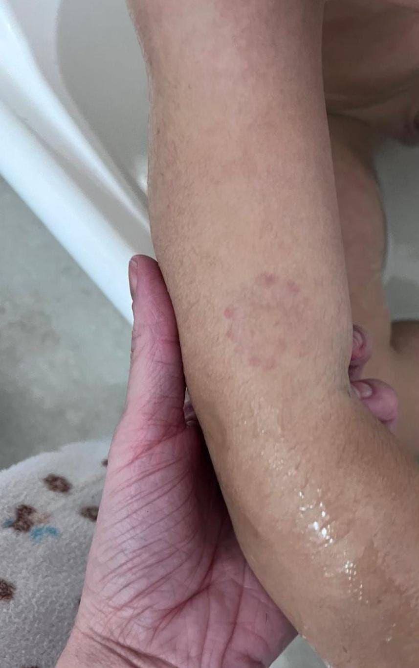Foto de um bra&ccedil;o de crian&ccedil;a com uma marca redonda no que parece ser uma mordida. 