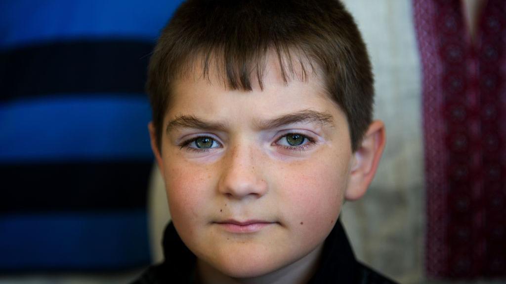 Un niño de ojos verdes y con quemaduras alrededor de sus ojos mira directo a la cámara