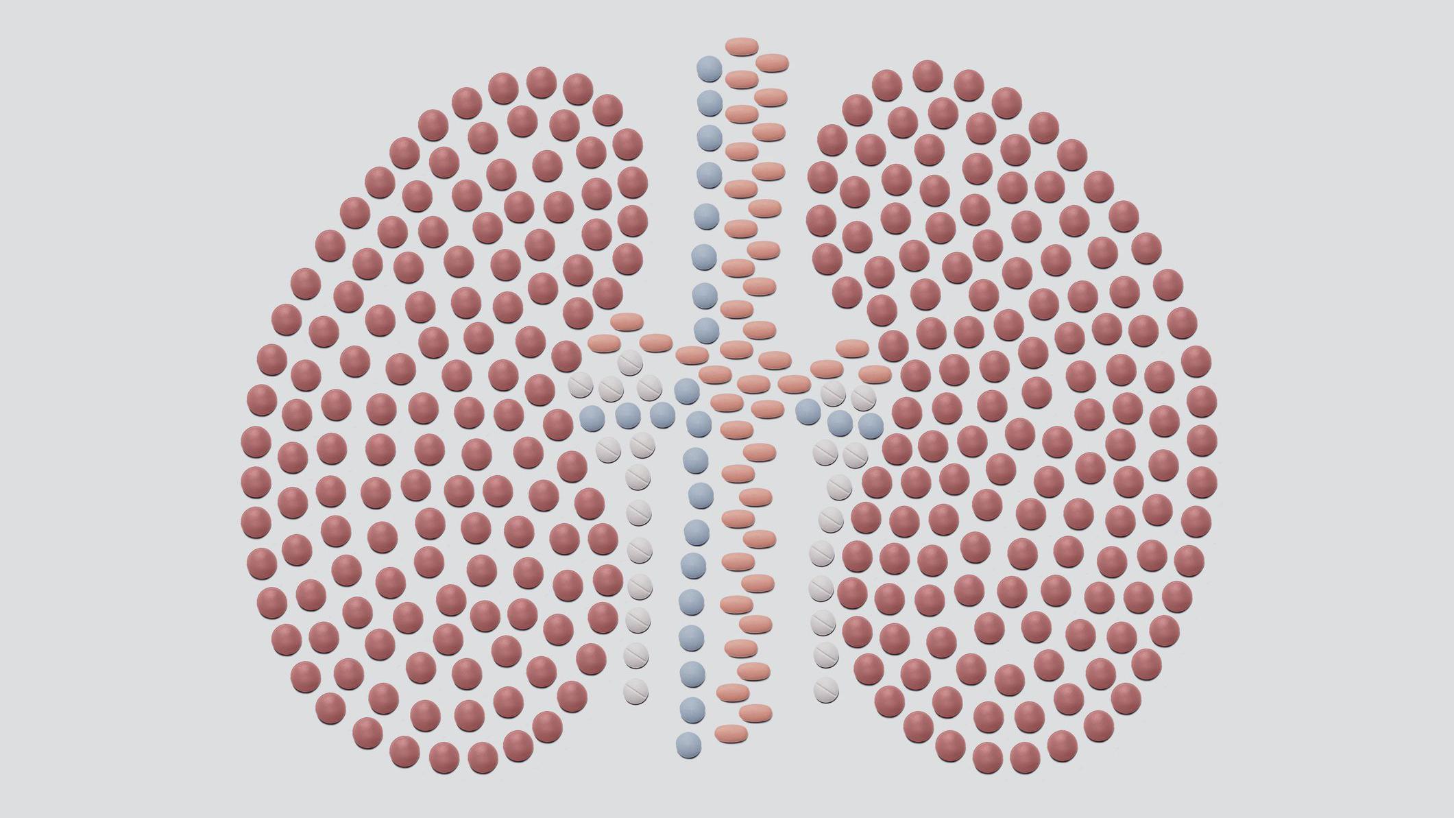 Ilustração de pulmões afetados pela síndrome de Eisenmenger