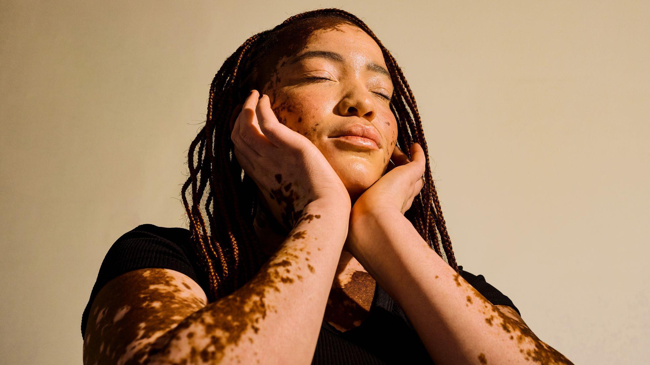 Mulher com vitiligo, que afeta a melamina da pele