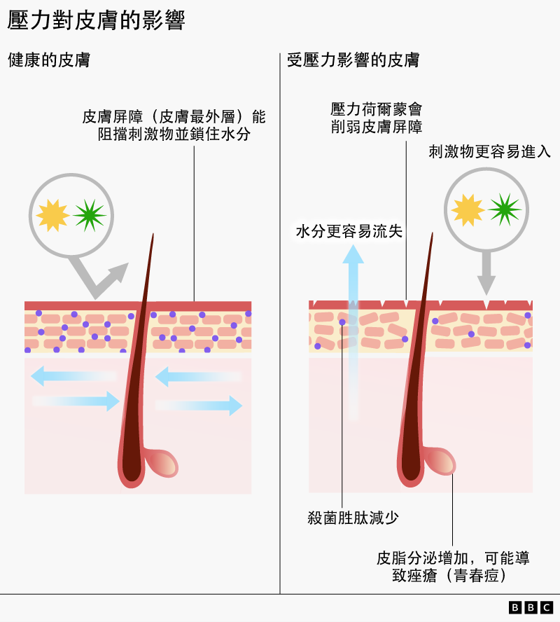壓力對皮膚影響圖解