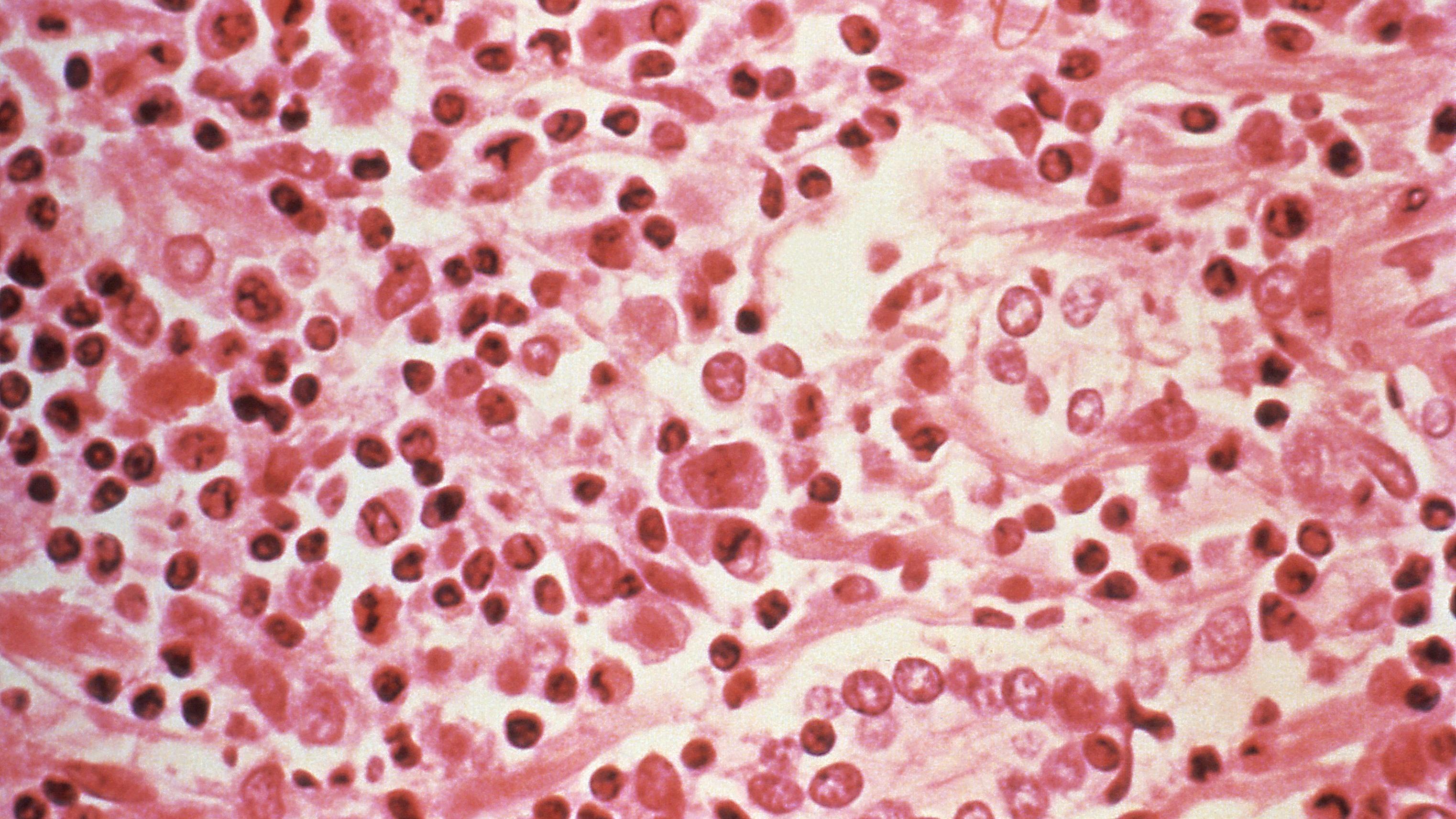Estudo microgr&aacute;fico de tecido hep&aacute;tico de um paciente com s&iacute;ndrome pulmonar por hantav&iacute;rus (HPS)