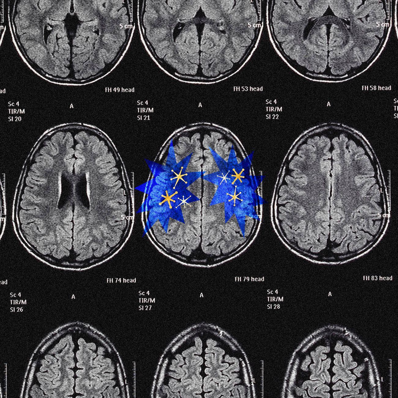設計圖片：一張電腦掃描膠卷片，上面以藍色圖形標記出大腦電波活動