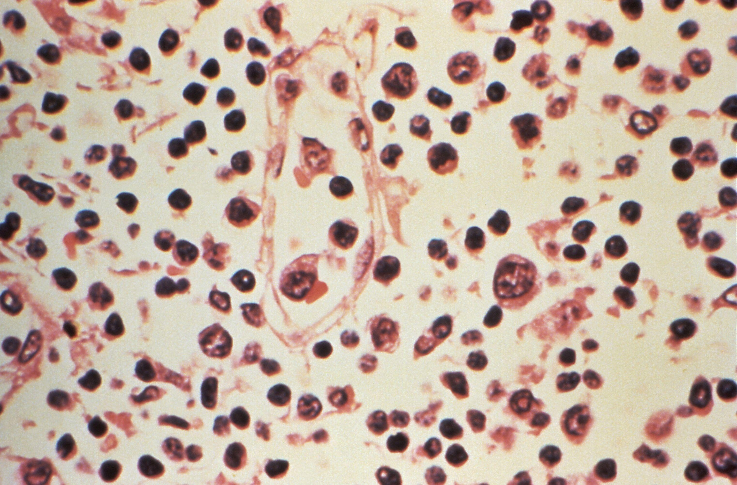 Amostra de linfonodo extra&iacute;da de um paciente com suspeita de infec&ccedil;&atilde;o por hantav&iacute;rus 