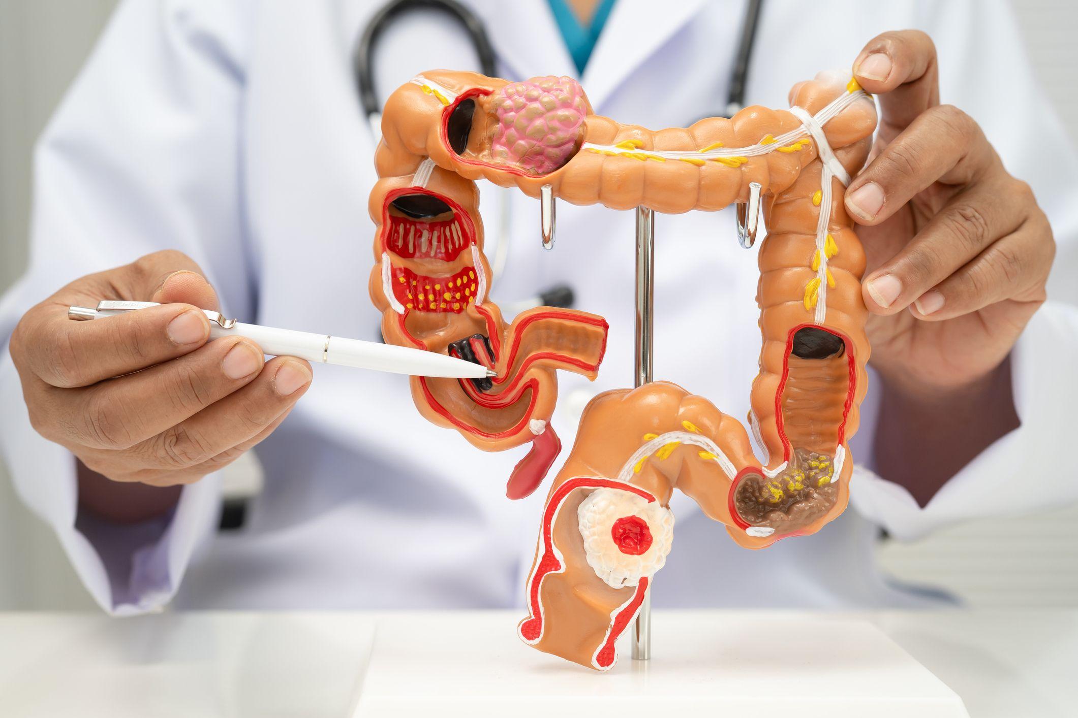 Un médico muestra una maqueta del intestino