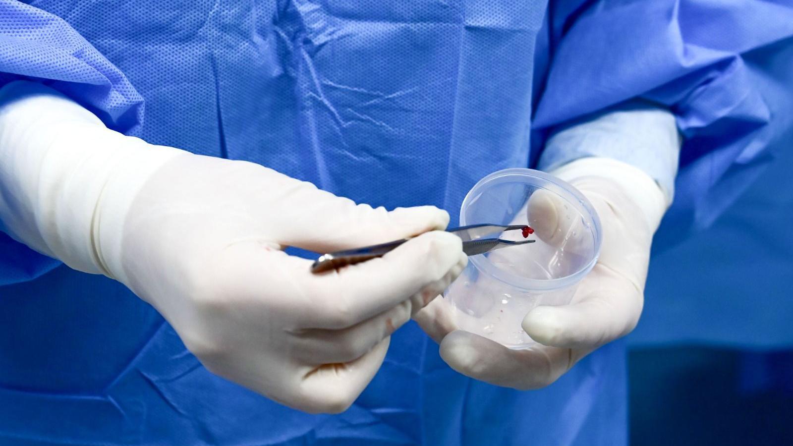 M&eacute;dico segura tumor com uma pin&ccedil;a antes de coloc&aacute;-lo num pote de pl&aacute;stico