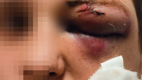 Un primer plano del ojo de Yaroslav después del ataque.
