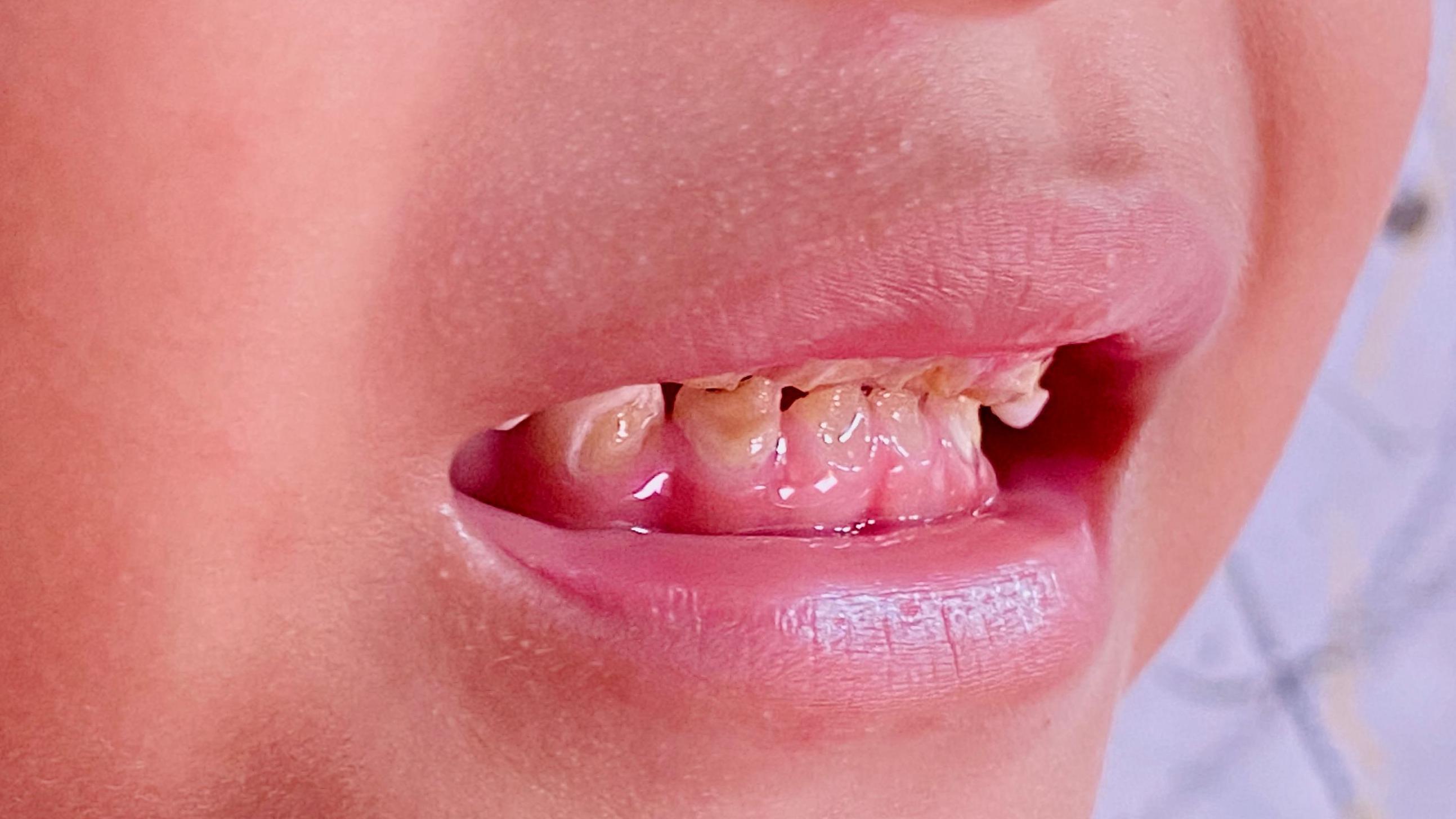 Close up photo of a toddler's teeth which are decayed