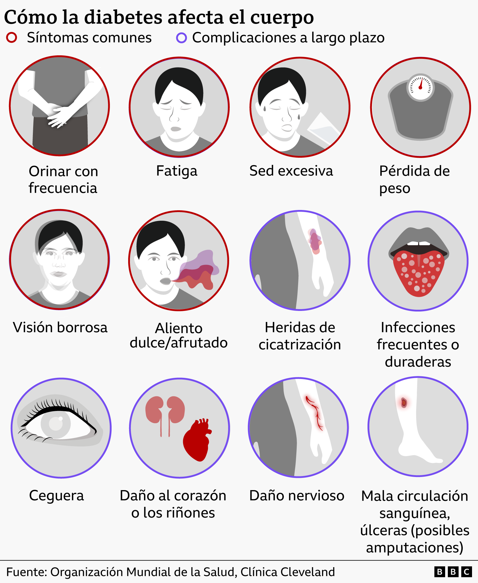 Un gráfico que muestra cómo la diabetes afecta al cuerpo. Los síntomas comunes incluyen la necesidad frecuente de orinar, la fatiga, la sed excesiva, la pérdida de peso, la visión borrosa y el aliento dulce y afrutado. Los síntomas a largo plazo incluyen heridas que cicatrizan lentamente, infecciones frecuentes o duraderas, ceguera, daños en el corazón o los riñones, daños en los nervios y un flujo sanguíneo deficiente. 