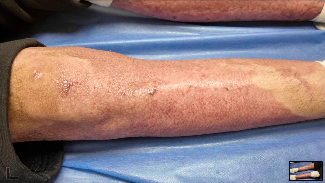 تسببت زراعة الجلد في تخفيض نسبة الحروق في جسد إبراهيم ل5% فقط