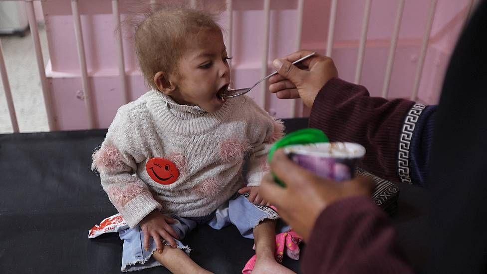 Un niño recibe tratamiento por desnutrición aguda en el hospital Nasser en el sur de Gaza en diciembre de 2025.