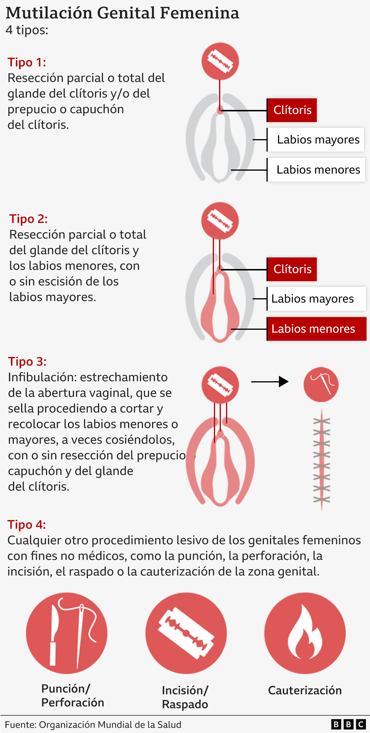 Los 4 tipos de mutilación genital femenina, según la OMS.