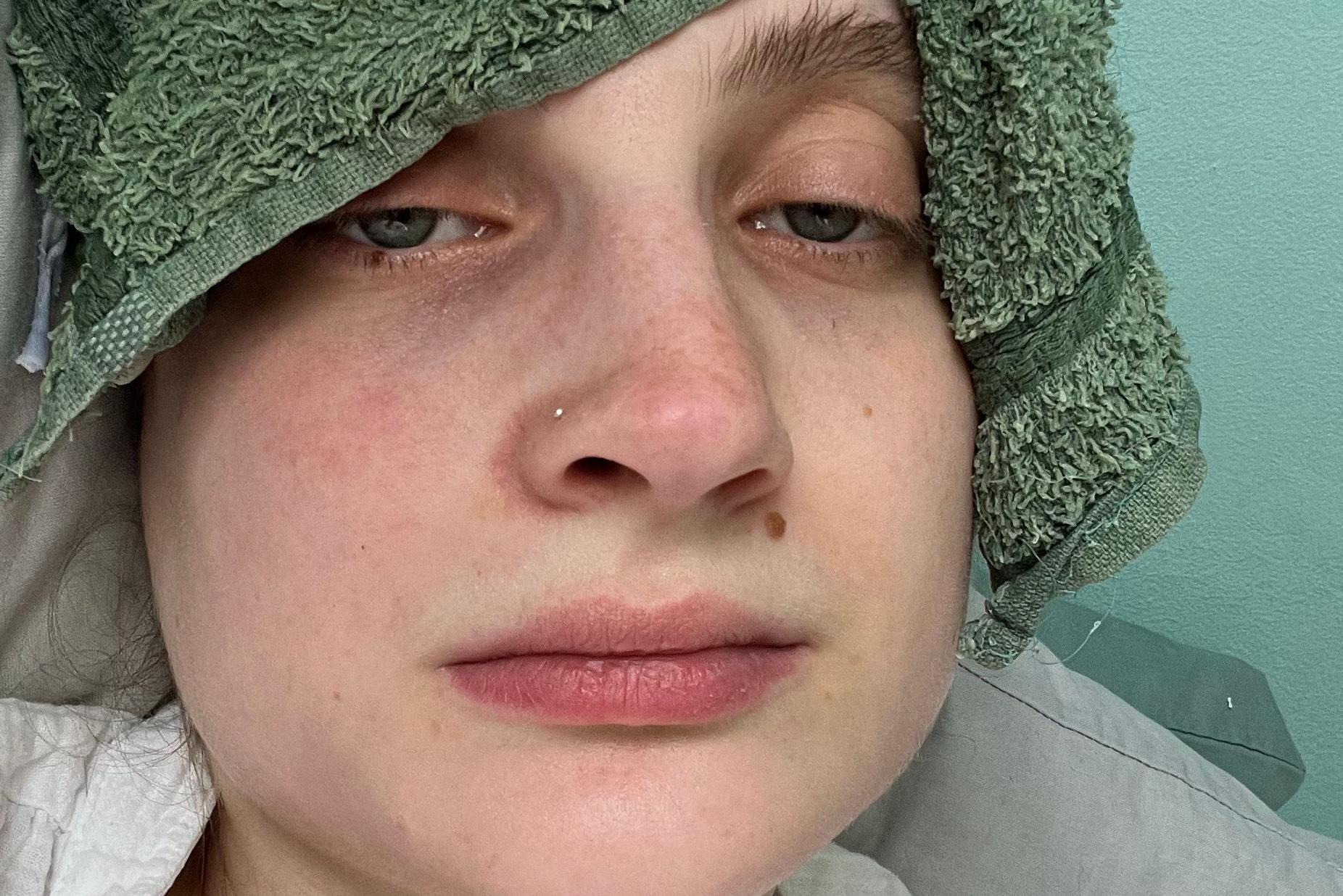 Ella Marcham aparenta indisposição e usa uma toalha úmido na testa