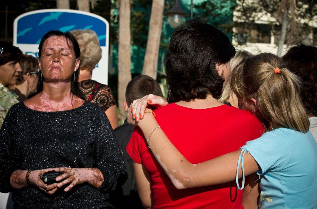 Varias personas con vitiligo