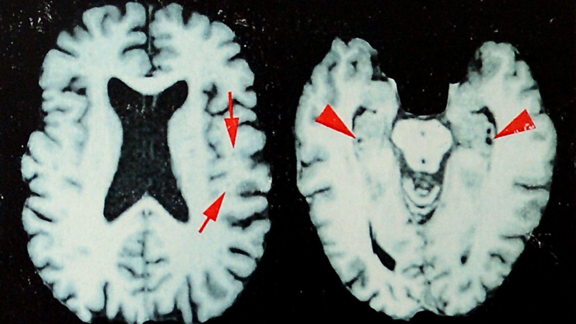 Brain disease in dead NFL players higher than previously shown