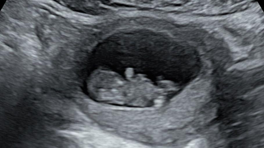 Um ultrassom fetal com imagem em preto e branco