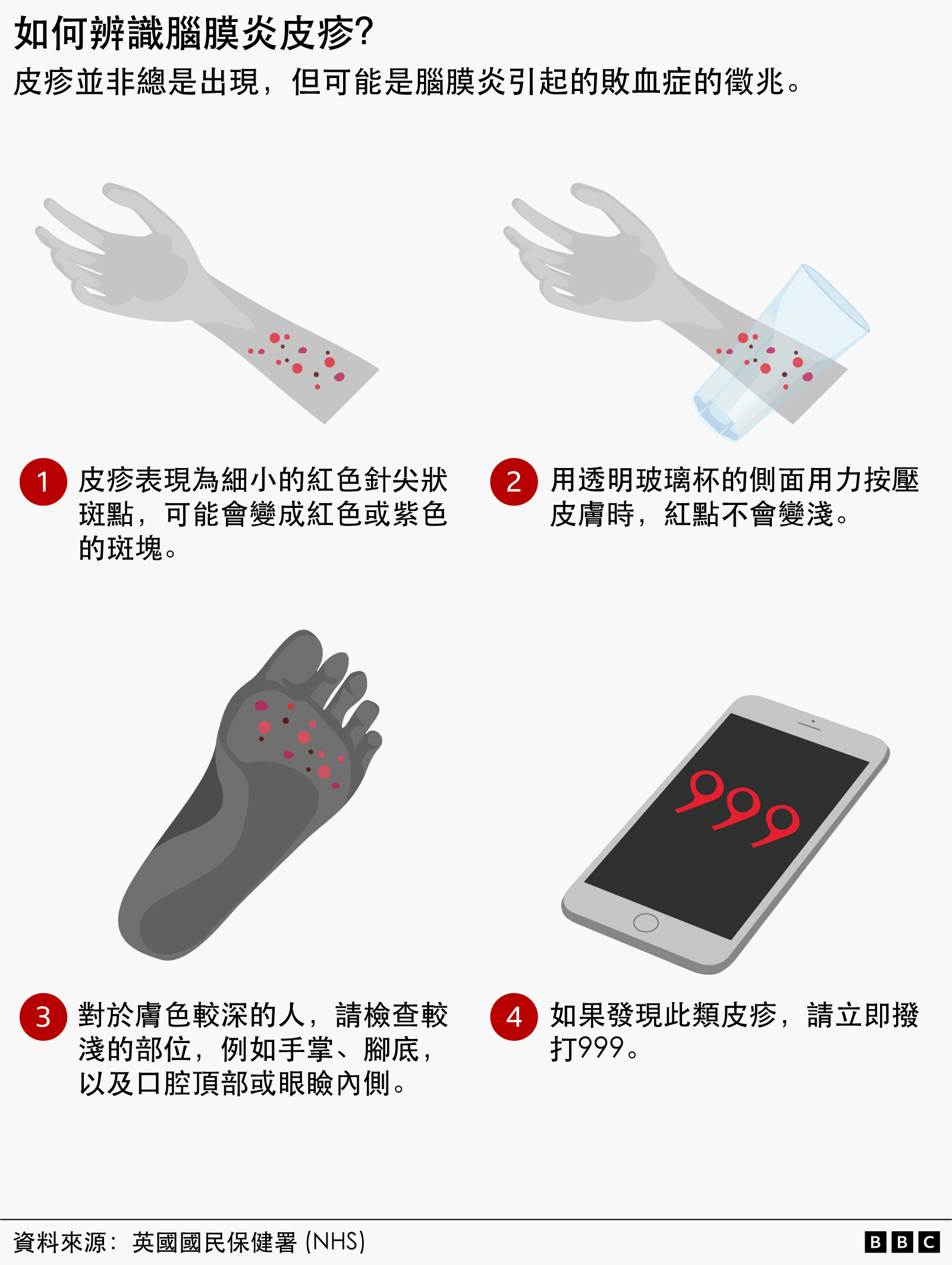 辨識腦膜炎皮疹