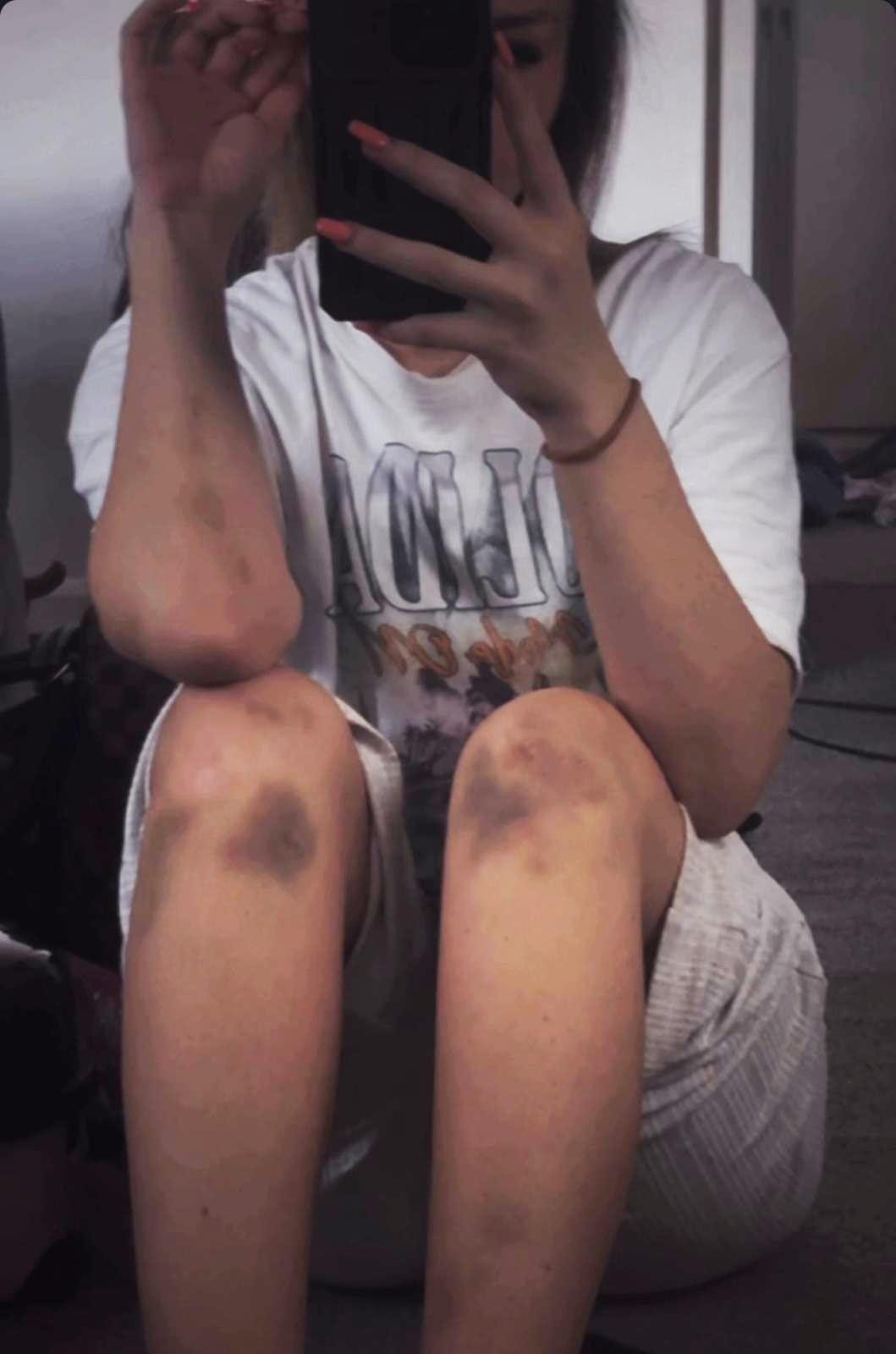 Selfie de Rebecca sentada, com o rosto encoberto pelo celular. Ela veste shorts cinza e apresenta hematomas escuros nos dois joelhos, al&eacute;m de marcas de hematomas nos bra&ccedil;os