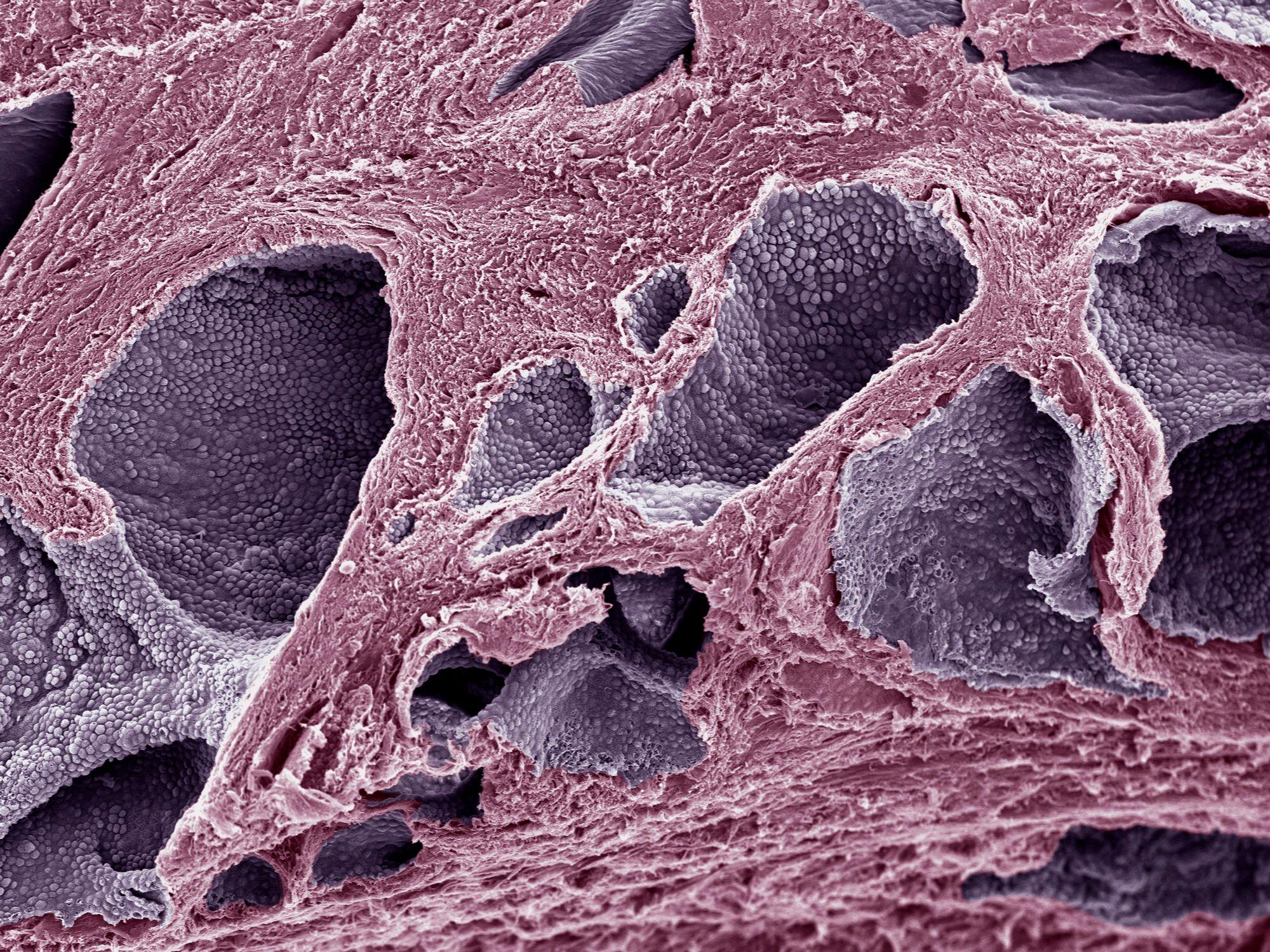 Células próstata cancerosas observadas bajo un microscopio electrónico