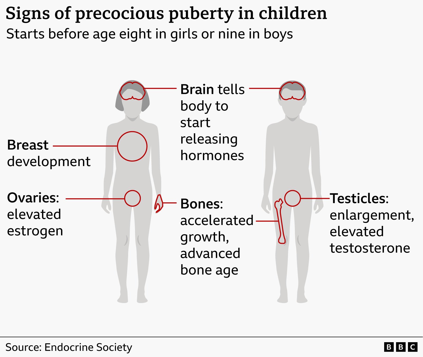 A graphic illustration of a male and female body labels the signs of precocious puberty in children.