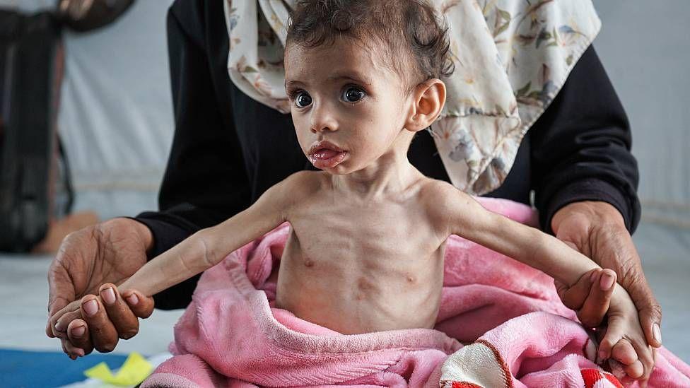Zakaria El-Mabhuh, un niño de 11 meses con desnutrición grave