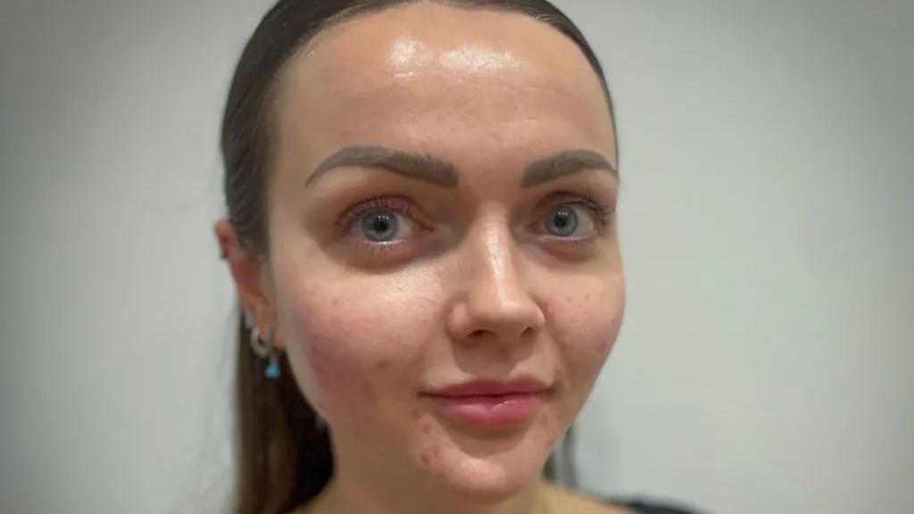  چہرے کی خوبصورتی کے لیے انجیکشن 