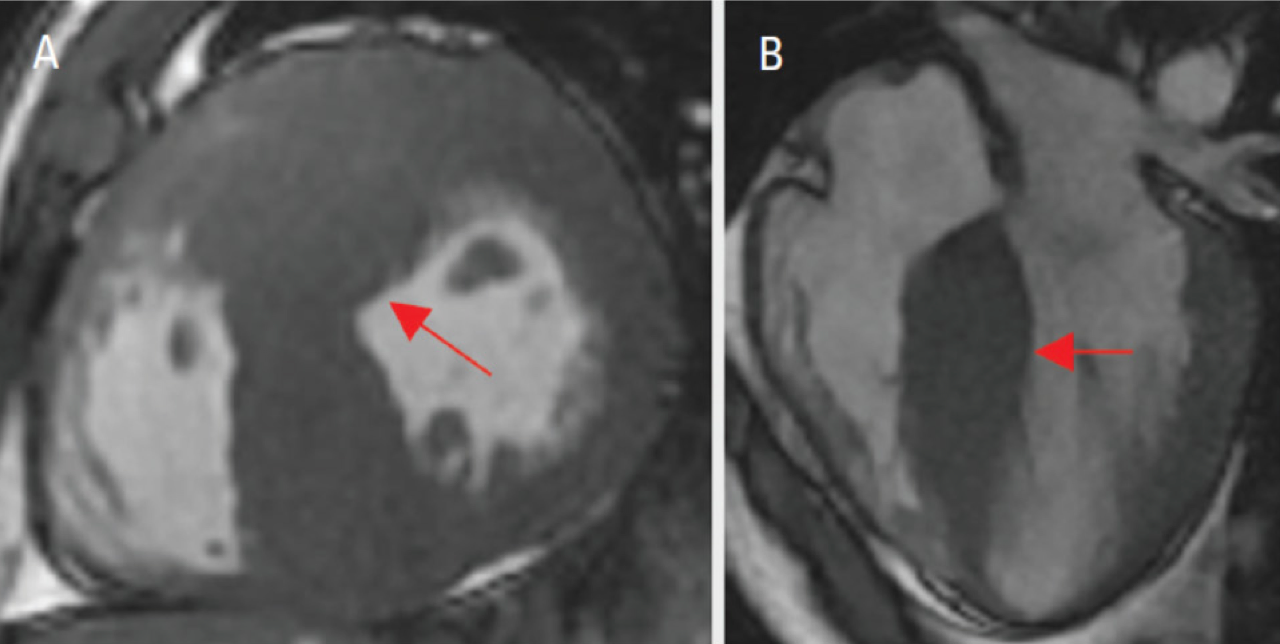 Duas imagens de resson&acirc;ncia magn&eacute;tica card&iacute;aca comparando um cora&ccedil;&atilde;o saud&aacute;vel de atleta com um cora&ccedil;&atilde;o com miocardiopatia hipertr&oacute;fica, mostrando a parede muscular do ventr&iacute;culo esquerdo visivelmente mais espessa no primeiro caso.
