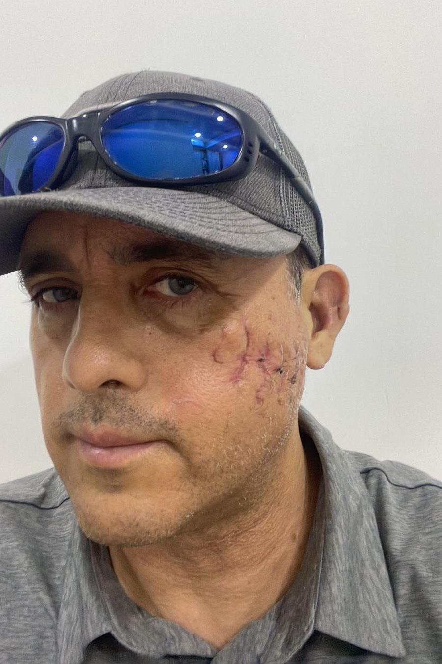 Mauricio mostra a cicatriz deixada no rosto após seu encontro com o tubarão-das-galápagos