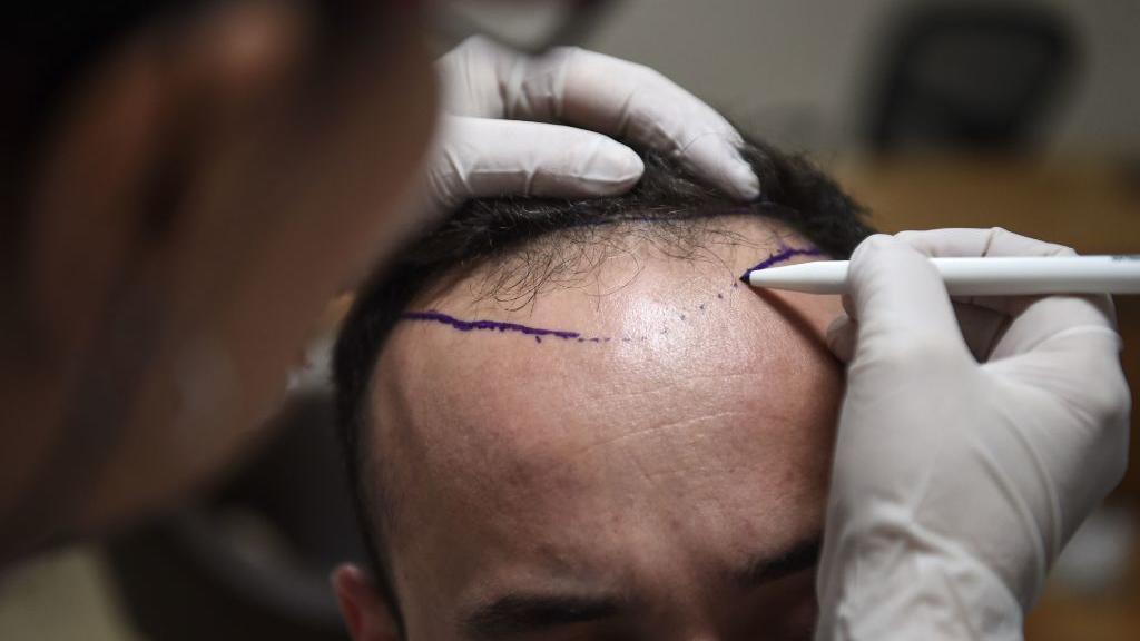 Un hombre haciéndose implantes capilares