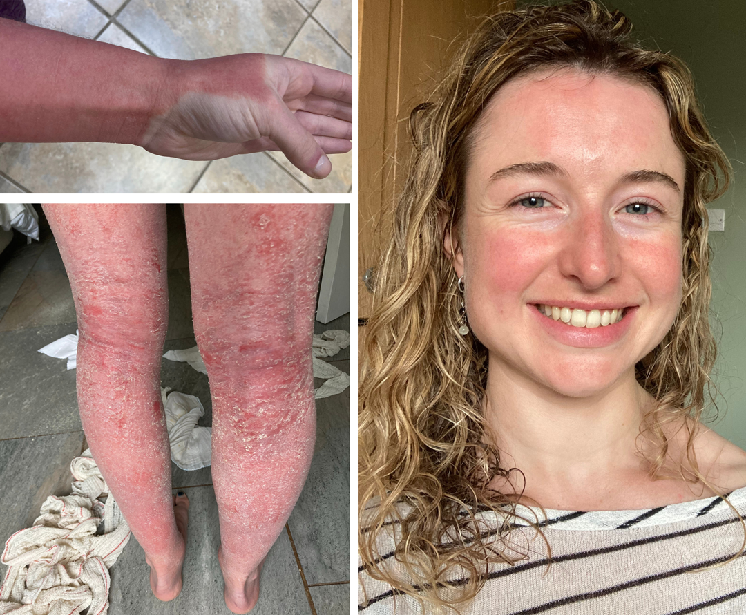 왼쪽에는 제나 크로스비의 다리와 팔이 심하게 붉어지고 물집이 생기며 피부가 벗겨지는 모습이 담겨 있다. 오른쪽에서는 피부 상태가 훨씬 나아진 모습으로 미소를 짓고 있다.