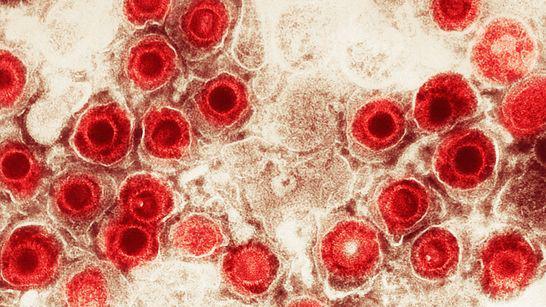 Vírus herpes simplex