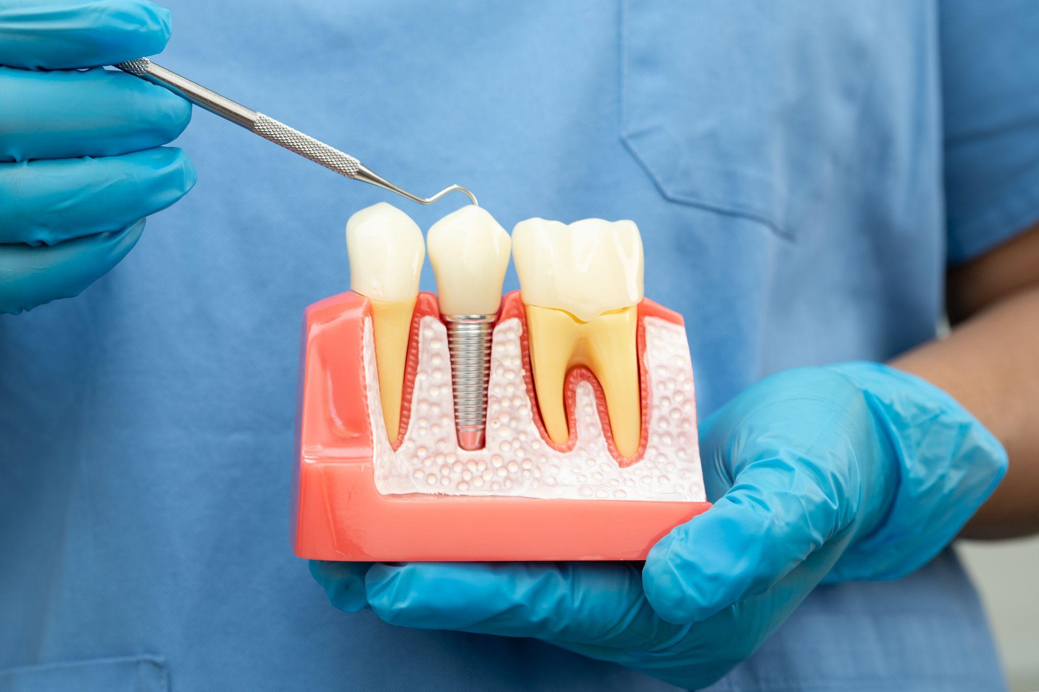 Un dentista sostiene un modelo de una corona dental.