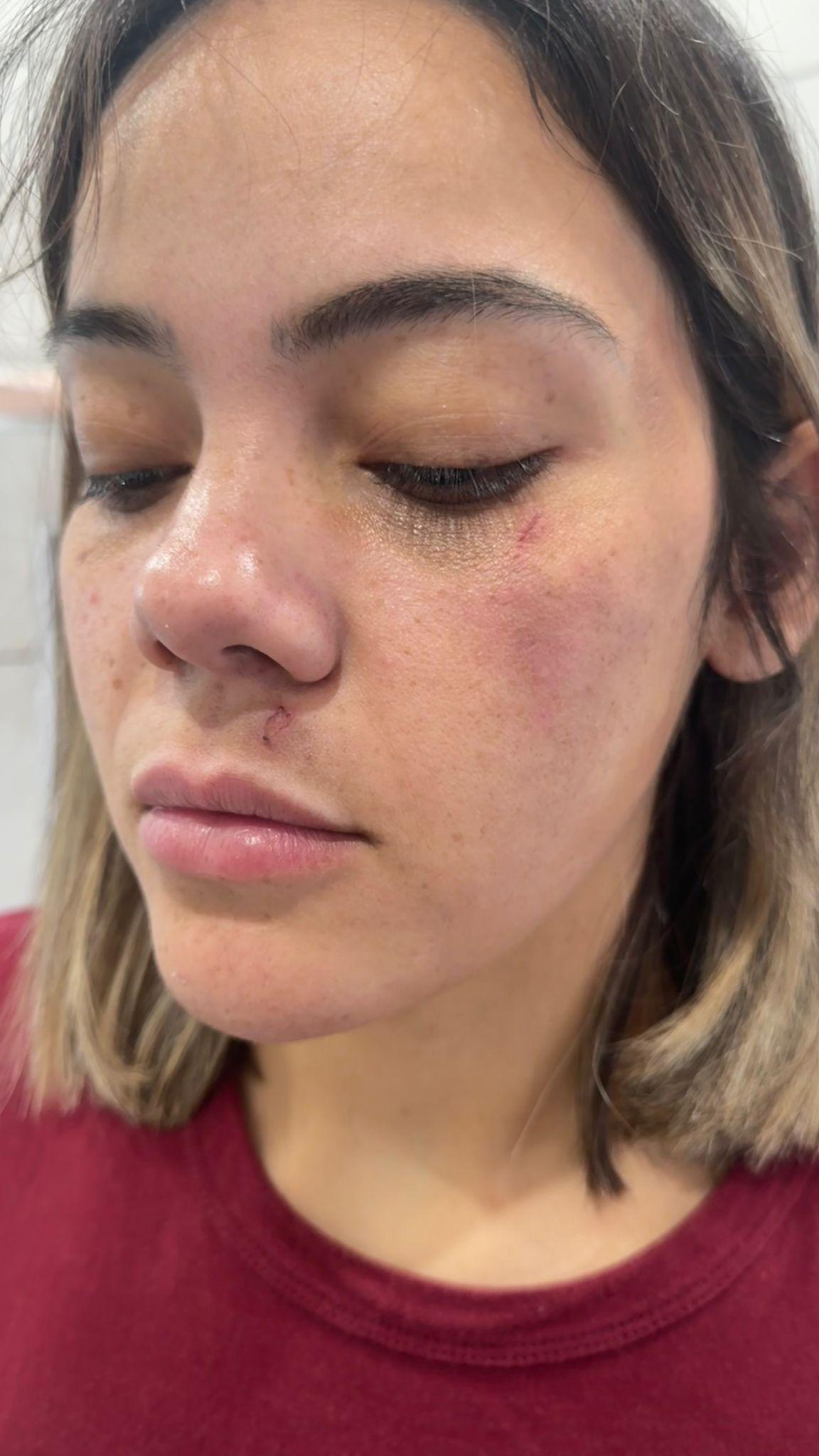 Foto do rosto de uma mulher com hematomas