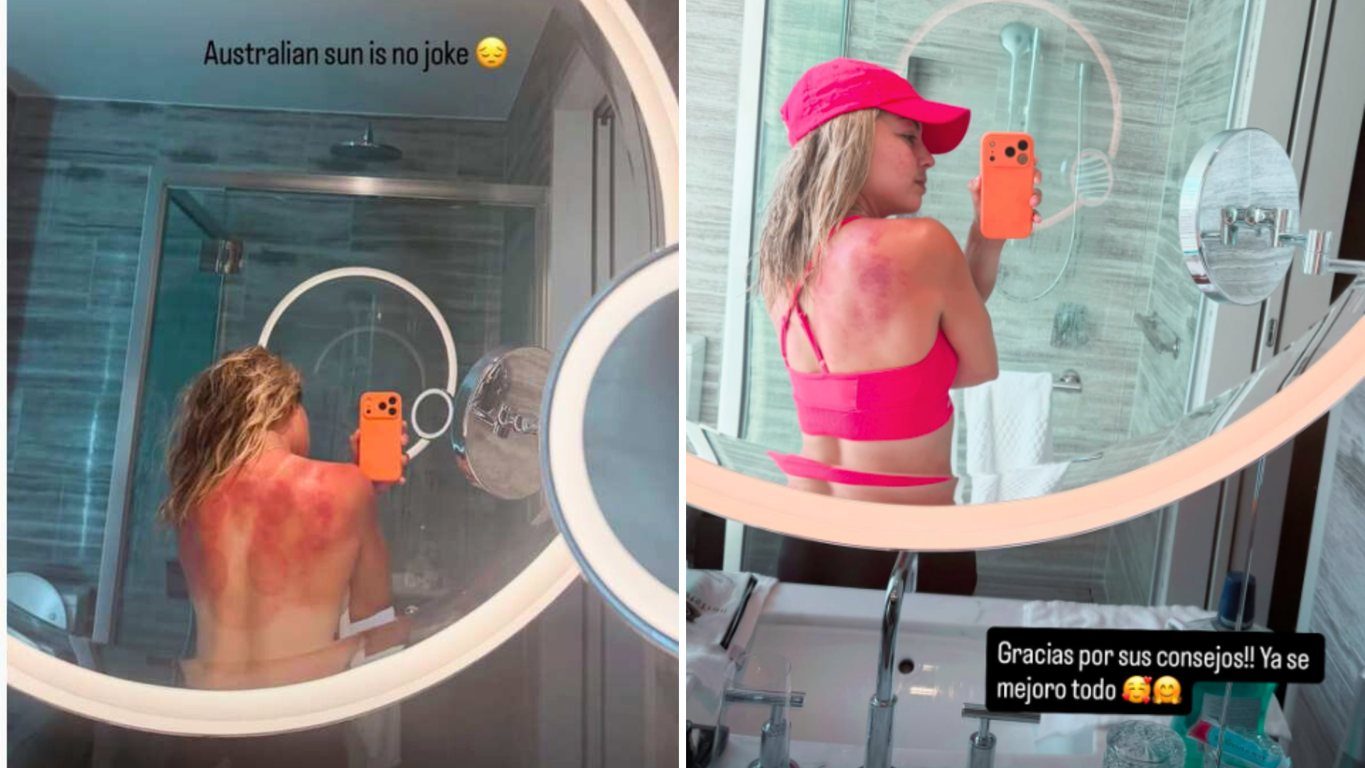 Dos fotos compartidas en Instagram por Renata Zarazúa, mostrando en una las quemaduras de sol que sufrió en la espalda y en la otra la mejoría que tuvo horas después