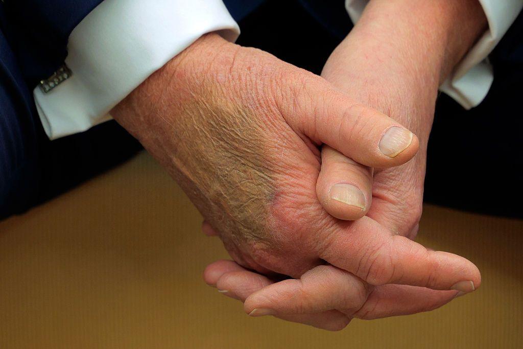 El maquillaje cubre un moretón en el dorso de la mano del presidente estadounidense Donald Trump mientras recibe al presidente francés Emmanuel Macron para reuniones en la Casa Blanca el 24 de febrero de 2025.