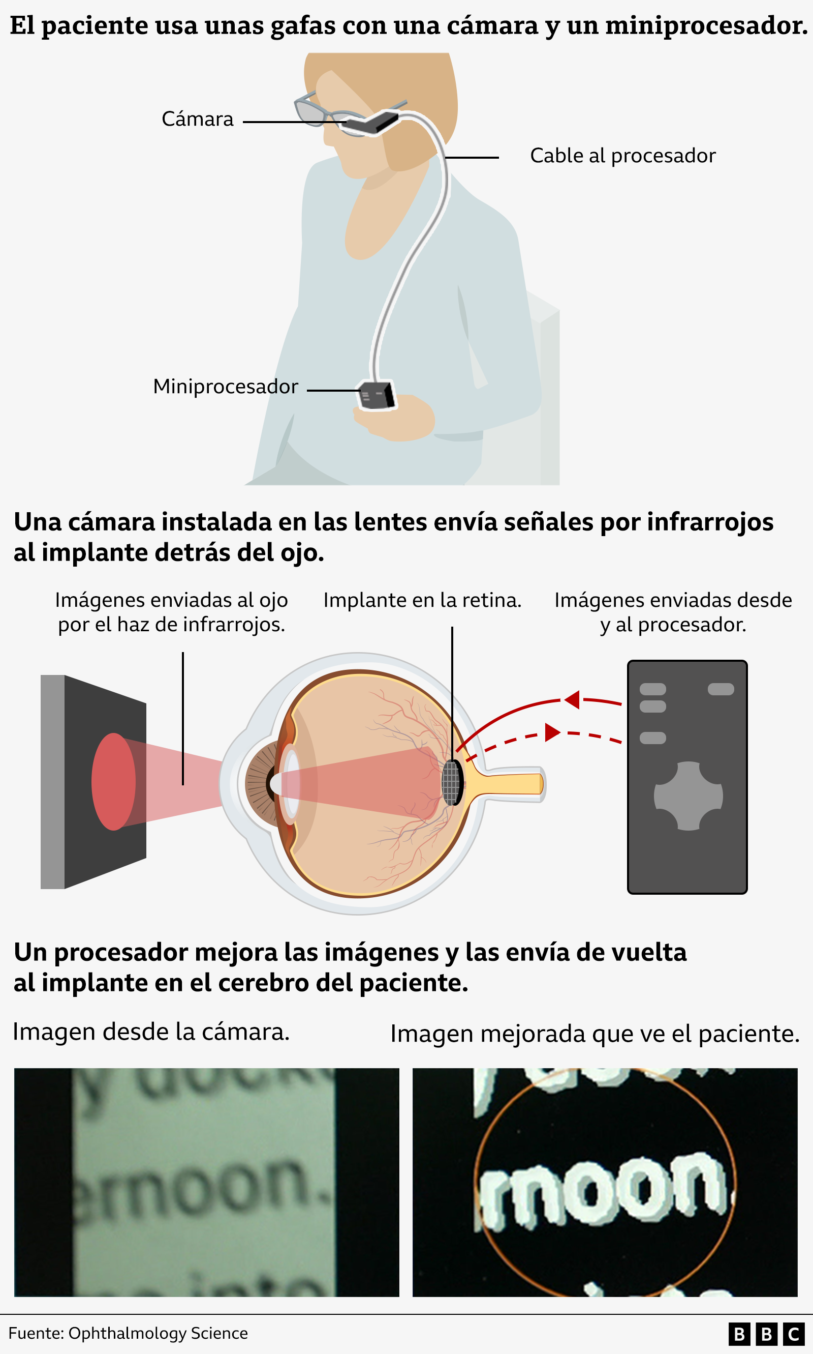 La gráfica muestra cómo funciona la tecnología. Hay una ilustración de un paciente con el implante que lleva gafas con una cámara de vídeo incorporada y que sostiene un procesador conectado por cable a las gafas.
Debajo, otra gráfica muestra cómo la cámara envía imágenes al implante en la parte posterior del ojo, a través de un haz infrarrojo. Un primer plano del ojo muestra el implante recibiendo esas imágenes infrarrojas y luego enviándolas a un procesador de mano negro. Unas flechas rojas destacan que las imágenes se envían al procesador, se mejoran y luego se devuelven al implante y, de ahí, al cerebro.
Una tercera gráfica ilustra la forma en que se mejoran las imágenes. A la izquierda hay una imagen de la cámara que muestra parte de una palabra. Las letras "ernoon" están coloreadas de negro sobre un fondo blanco y aparecen ligeramente borrosas. A la derecha hay una imagen mejorada vista por el paciente donde las letras (ahora blancas) están en negrita y resaltan sobre un fondo negro.