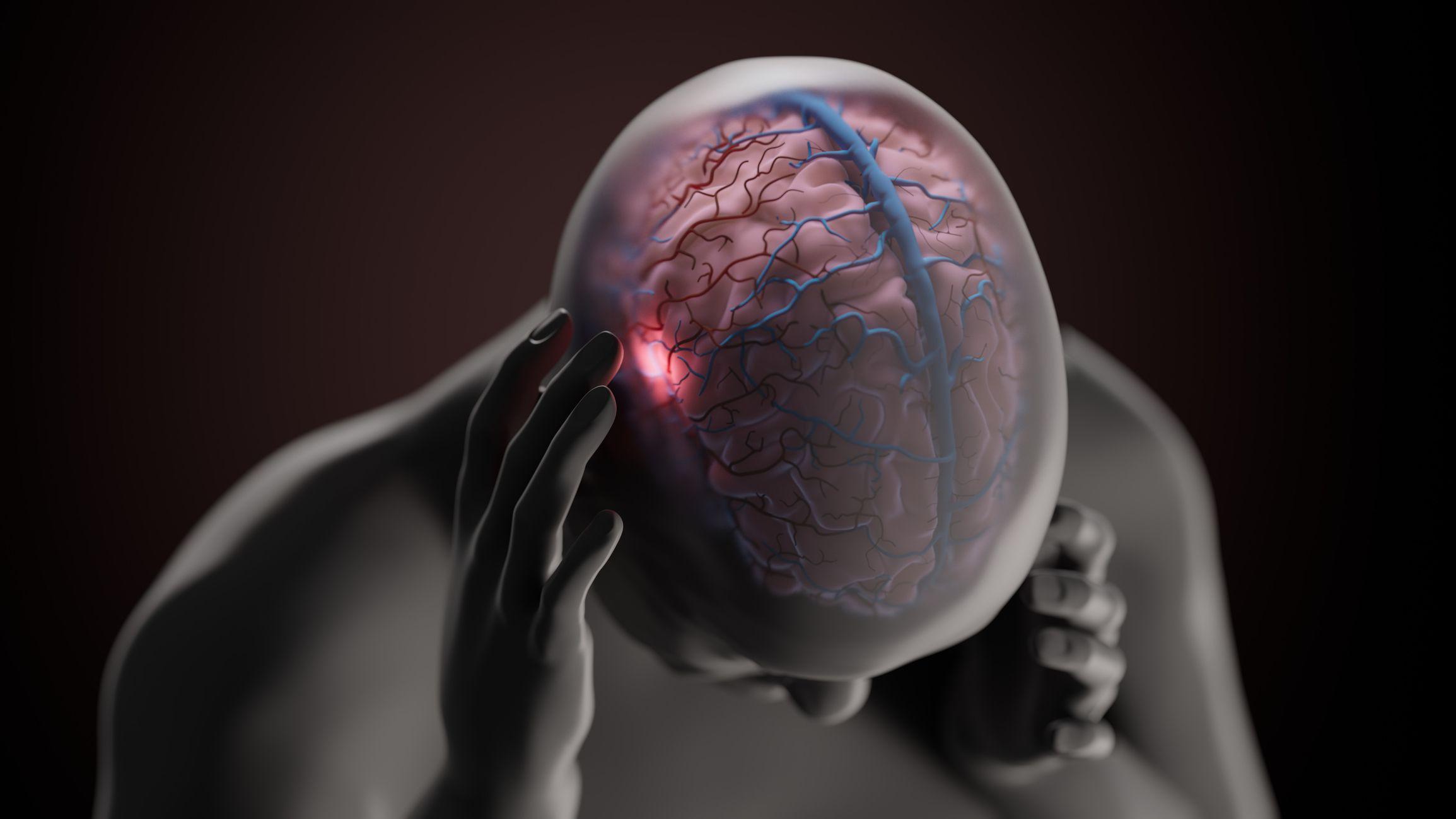 Ilustración conceptual de los síntomas de dolor originados por una migraña 