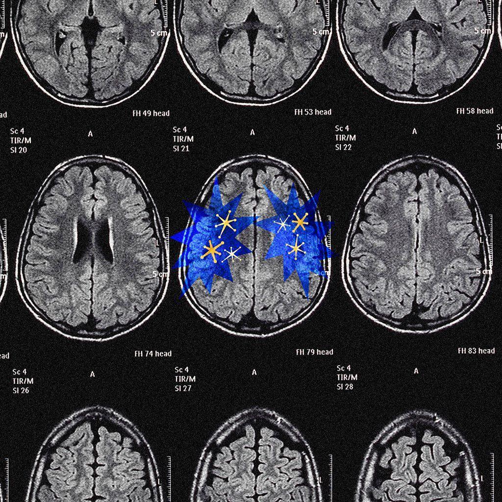 Serie de imágenes de resonancia magnética cerebral con figuras estrelladas azules superpuestas en la región central del cerebro.