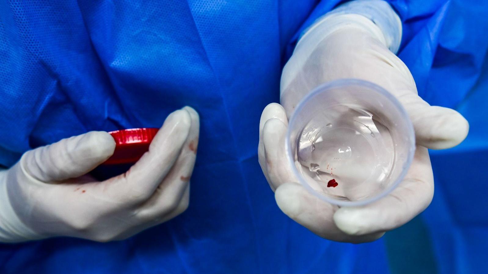 M&atilde;os de um profissional da sa&uacute;de, com luvas de pl&aacute;stico, seguram um pote com um pequeno tumor avermelhado