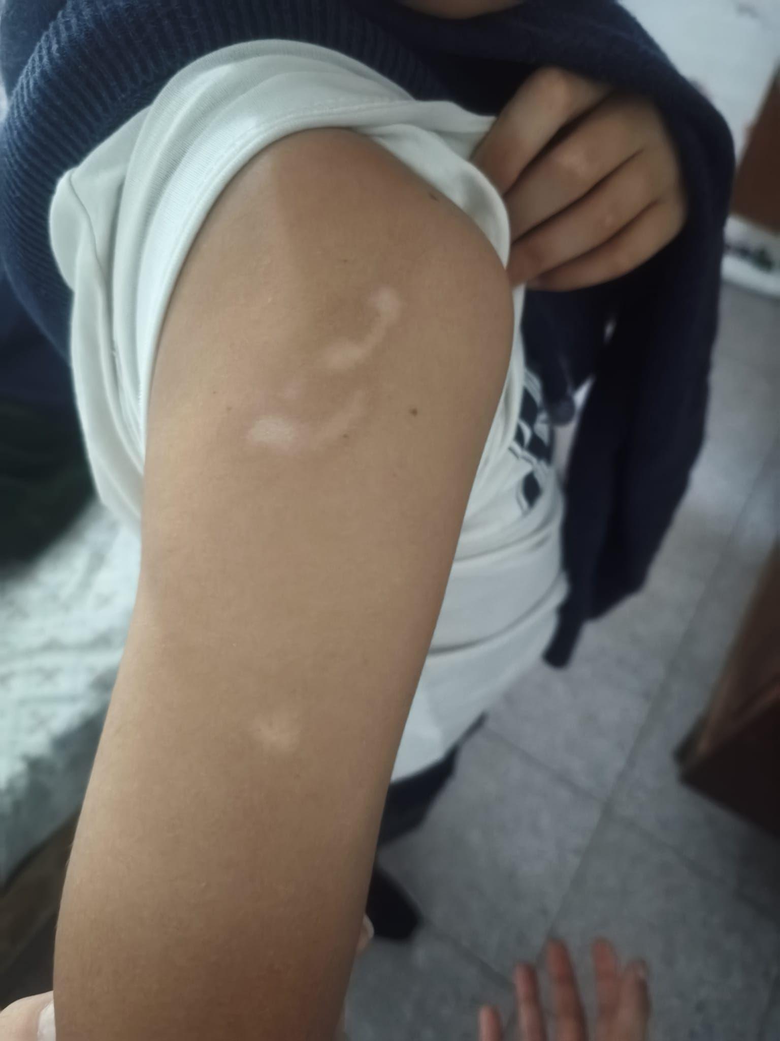 Criança mostra braço com cicatrizes