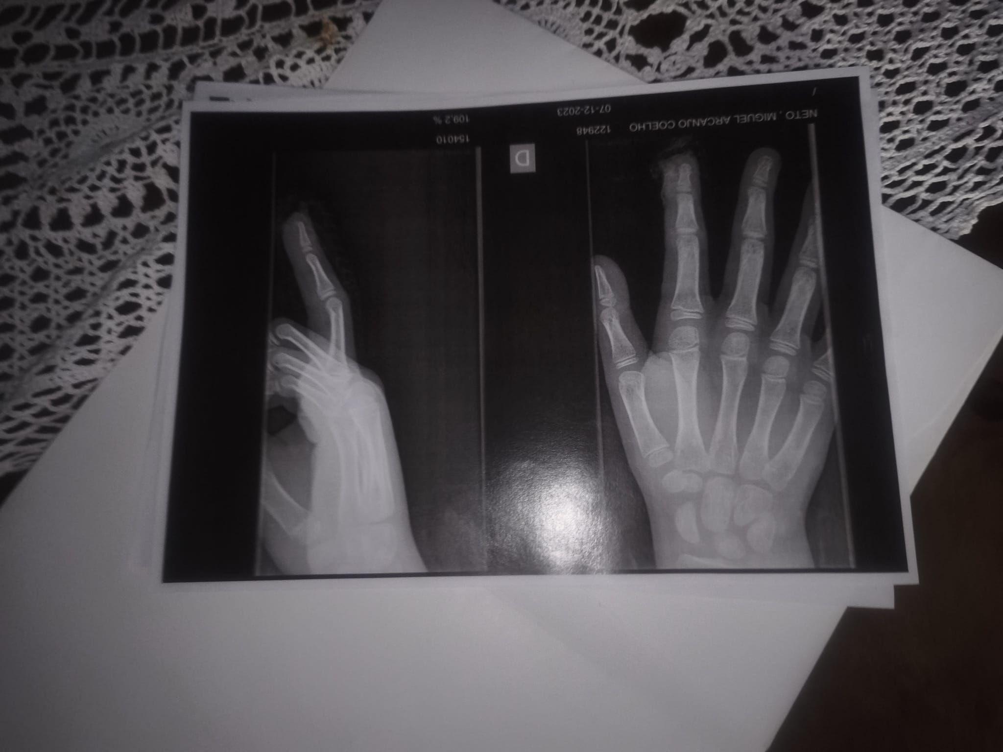 Foto mostra raio-x tirado por Miguel após incidente na escola