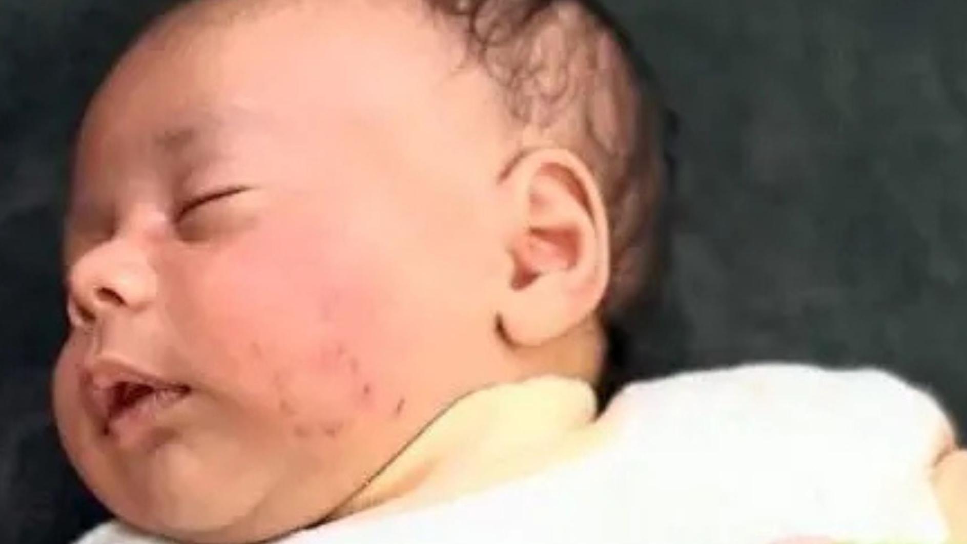 Adam Youseff, con el pelo castaño y dormido, muestra cicatrices en la cara causadas por mordeduras de comadreja. 