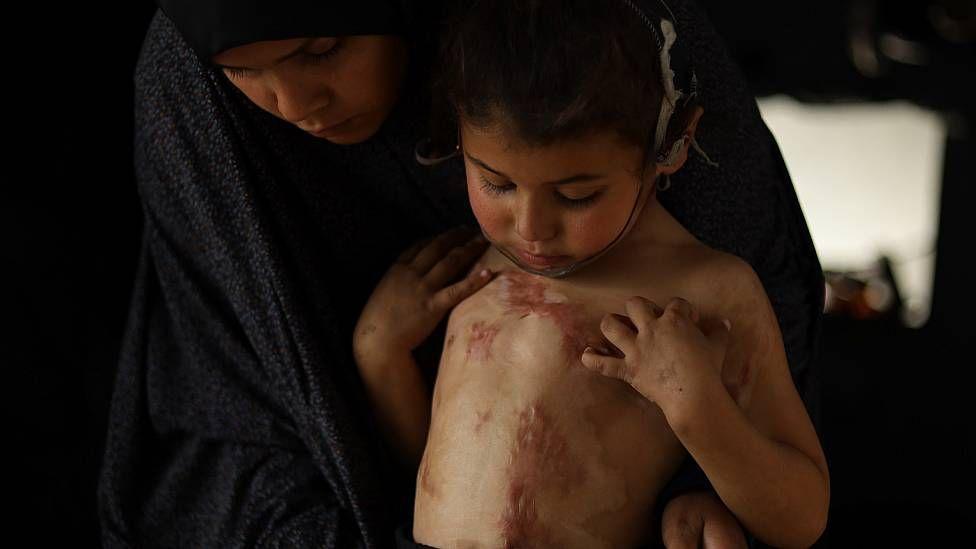 Una madre en Gaza muestra las extensas cicatrices de quemaduras en el tórax y abdomen de su hija pequeña 