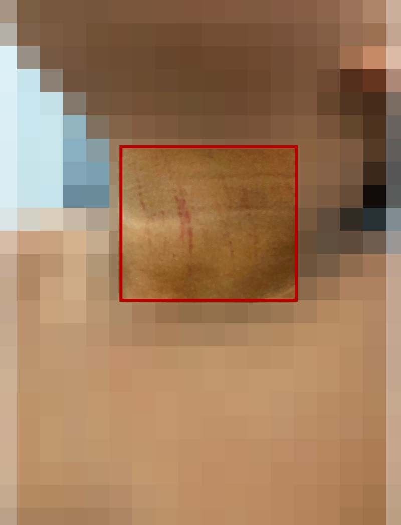 Na foto, em que o rosto da criança está borrado, é possível ver marcas deixadas no pescoço