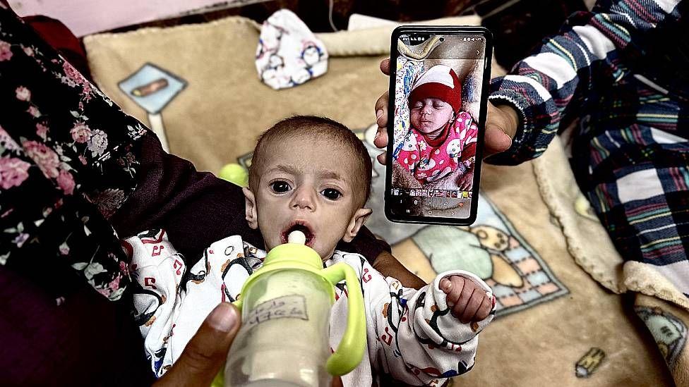 Suwar Ashur, de 5 meses, recibe tratamiento por desnutrición en el Hospital Nasser en Khan Yunis, Gaza, el 1 de mayo de 2025.