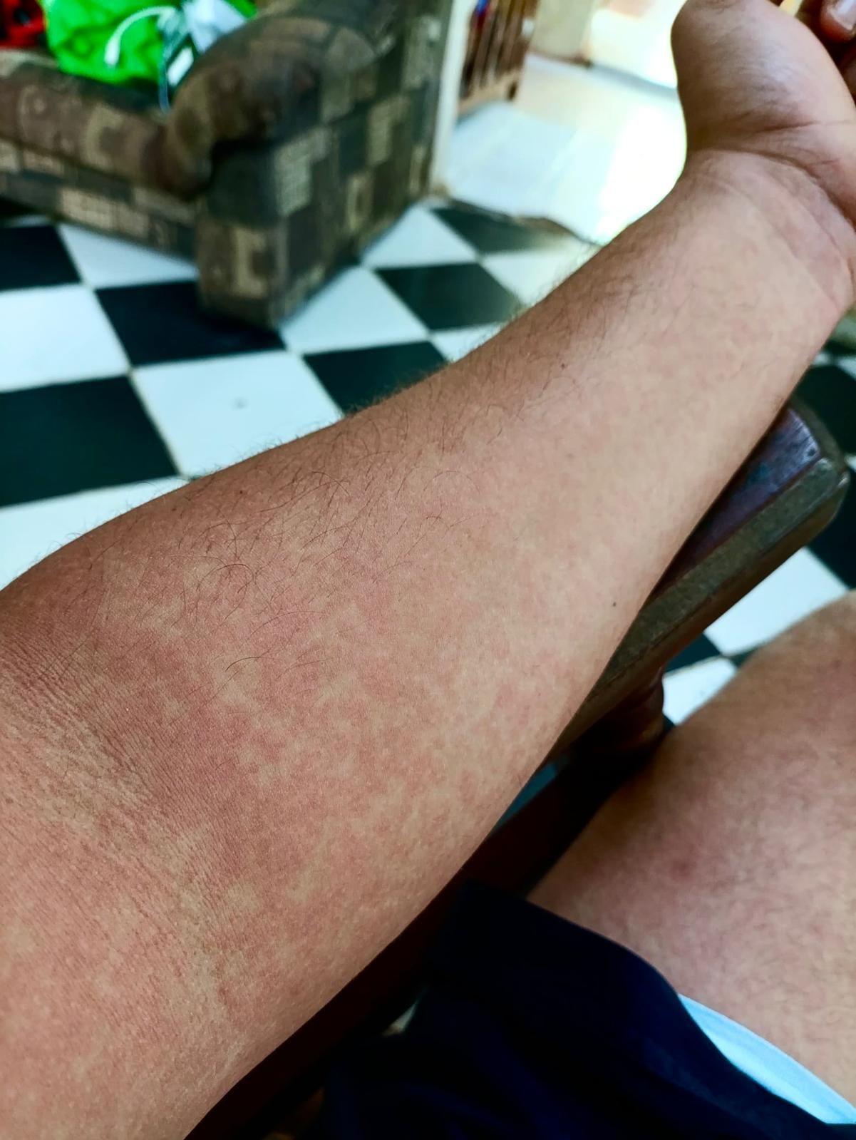 Brazo con sarpullido de Hansel