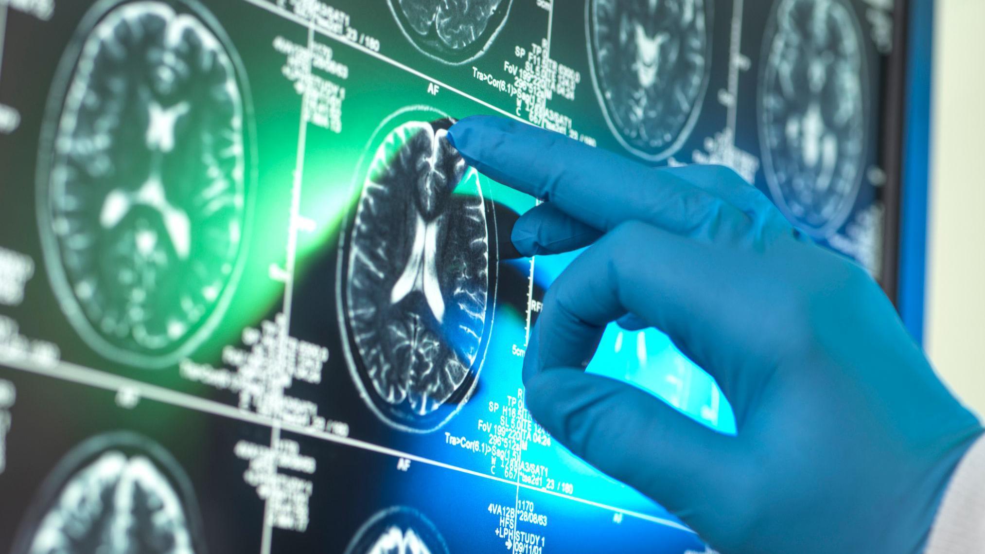 Breakthrough Alzheimers drugs unlikely to benefit patients, report suggests 