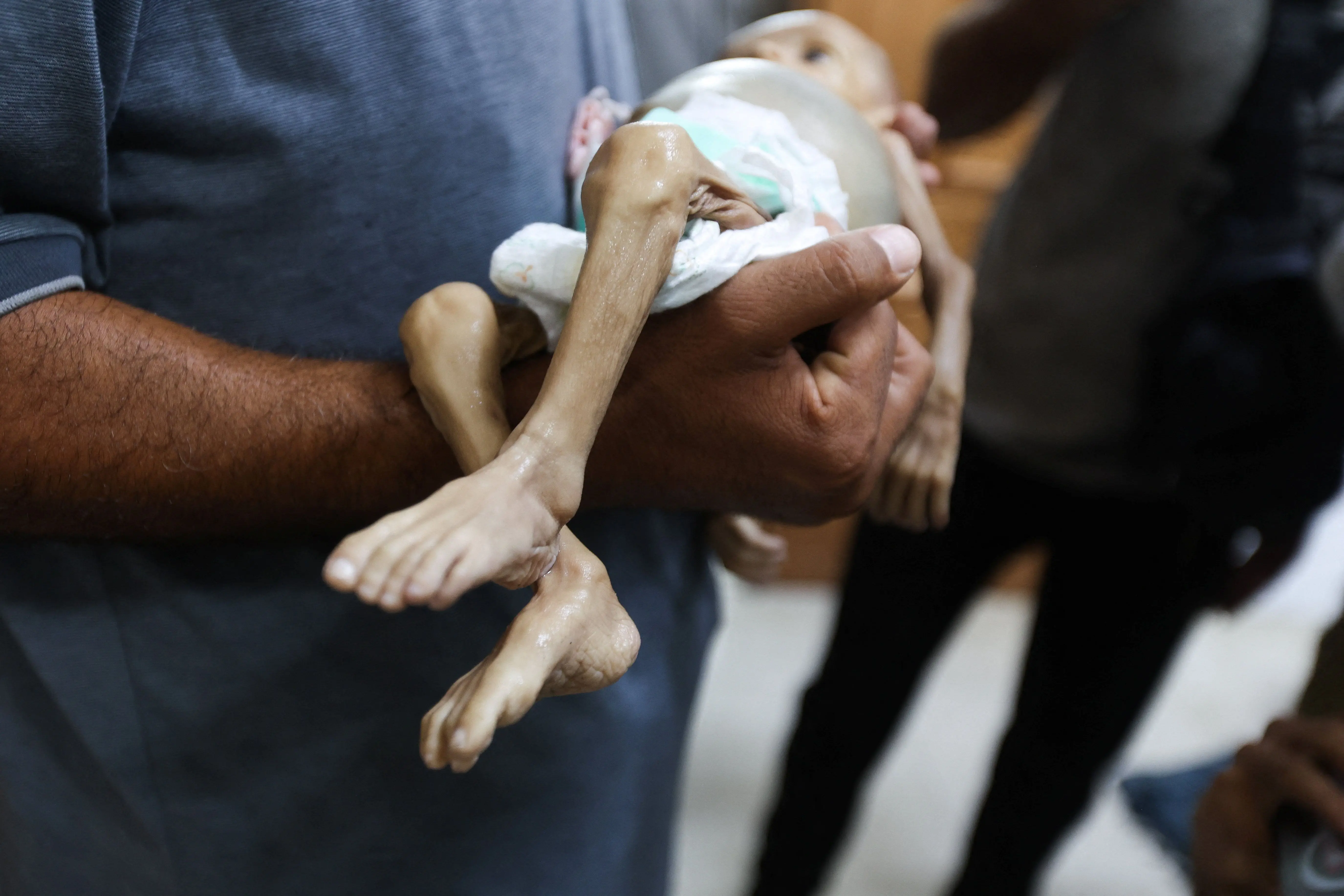 الطفلة الفلسطينية زينب أبو حليب، التي توفيت بسبب سوء التغذية في مستشفى ناصر في خان يونس، جنوب قطاع غزة