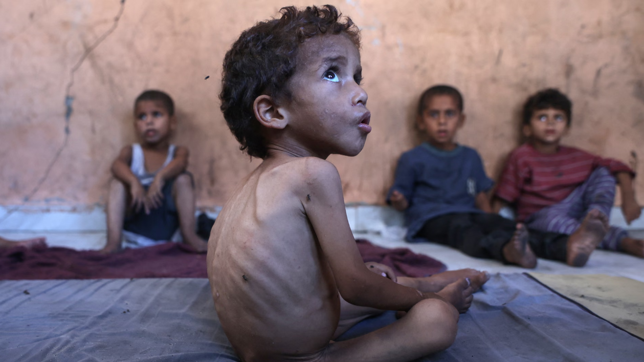 أطفال غزيون يعانون سوء التغذية الحاد 